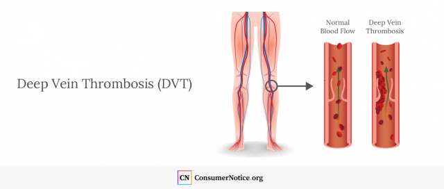 Infographic of deep vein thrombosis (DVT)
