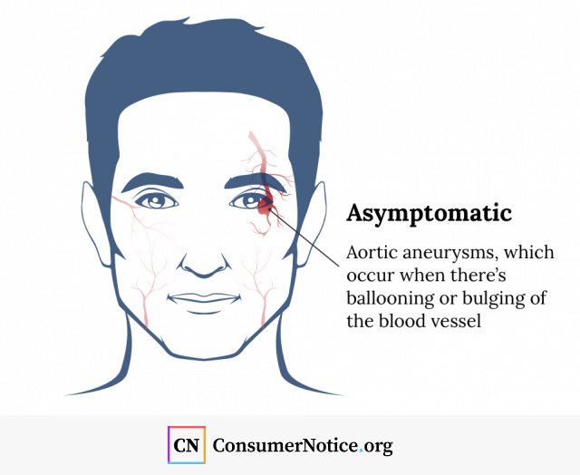 Infographic that illustrates aortic aneurysms