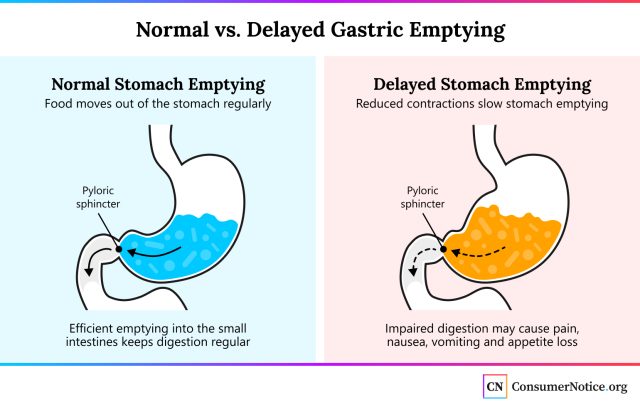 An illustrative comparison image of what a stomach looks like during normal digestion vs. a stomach experiencing delated gastric emptying.