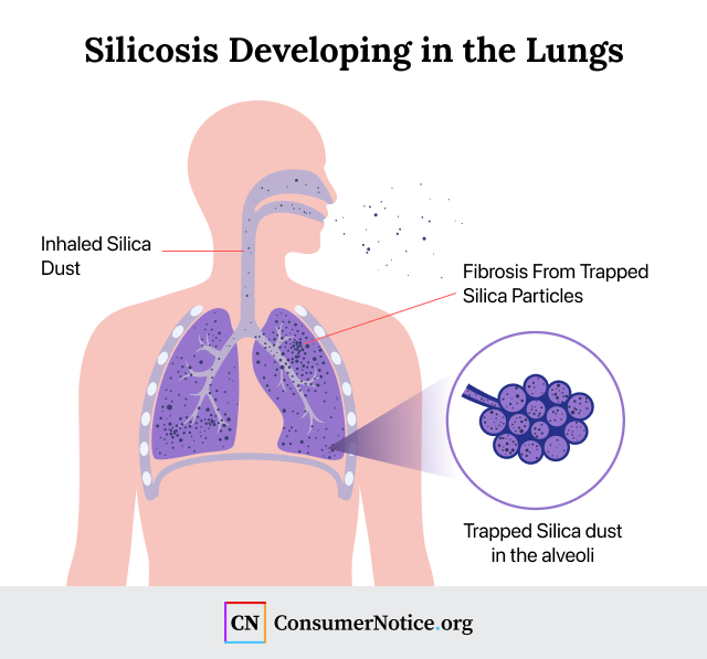 Silicosis developing in the lungs