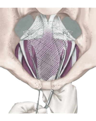 transvaginal mesh