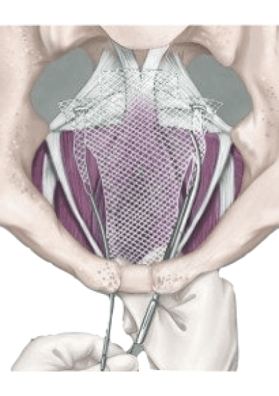 transvaginal mesh