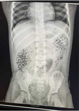 X-ray of water beads in a stomach