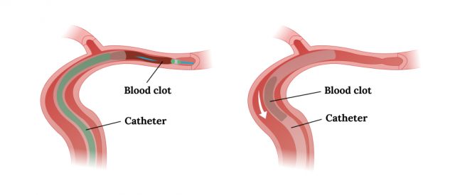 How Jet 7 Xtra Flex Catheters Work