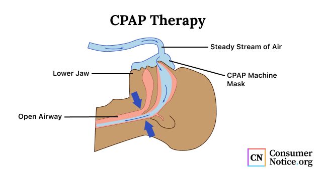 Graphic describing how a CPAP machine works to treat sleep apnea