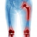 xray showing exactech knee and hip placements