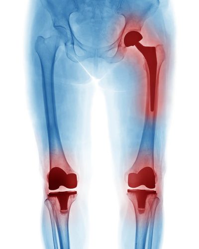 xray showing exactech knee and hip placements