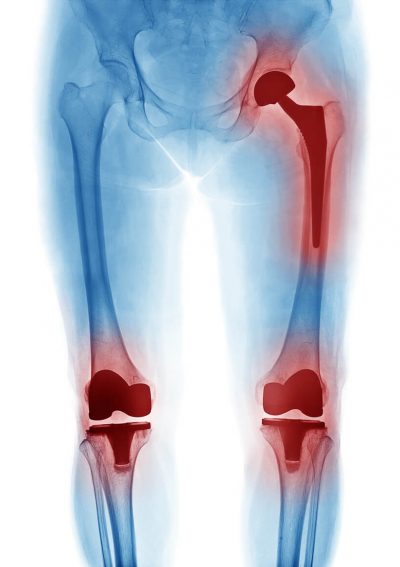 xray showing exactech knee and hip placements