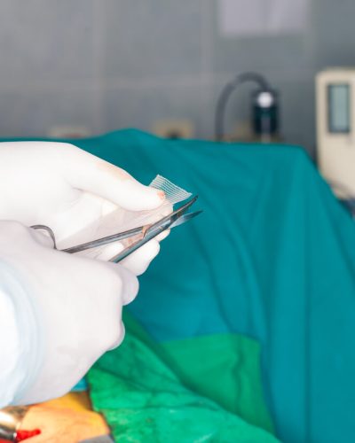 Surgeon cutting a piece of hernia mesh