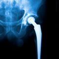 Hip replacement x-ray