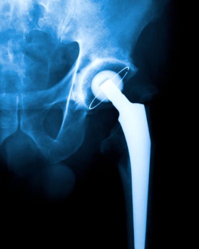 Hip replacement x-ray