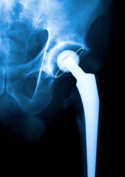 Hip replacement x-ray