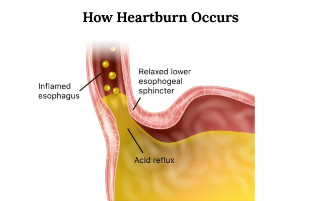 Acid reflux or heartburn happens when acid from the stomach backs up into the esophagus.