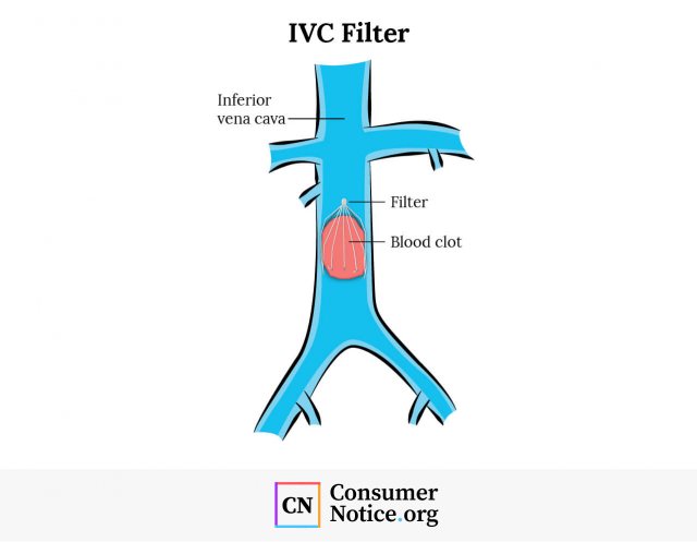 Diagram showing how an IVC filter works