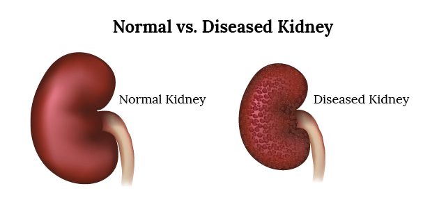 Infographic comparing Healthy vs. Diseased Kidney