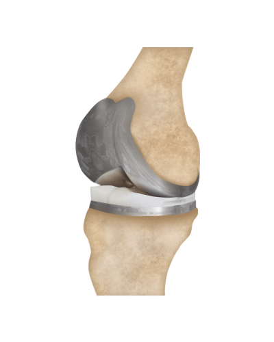 knee replacement
