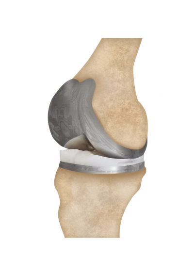 knee replacement