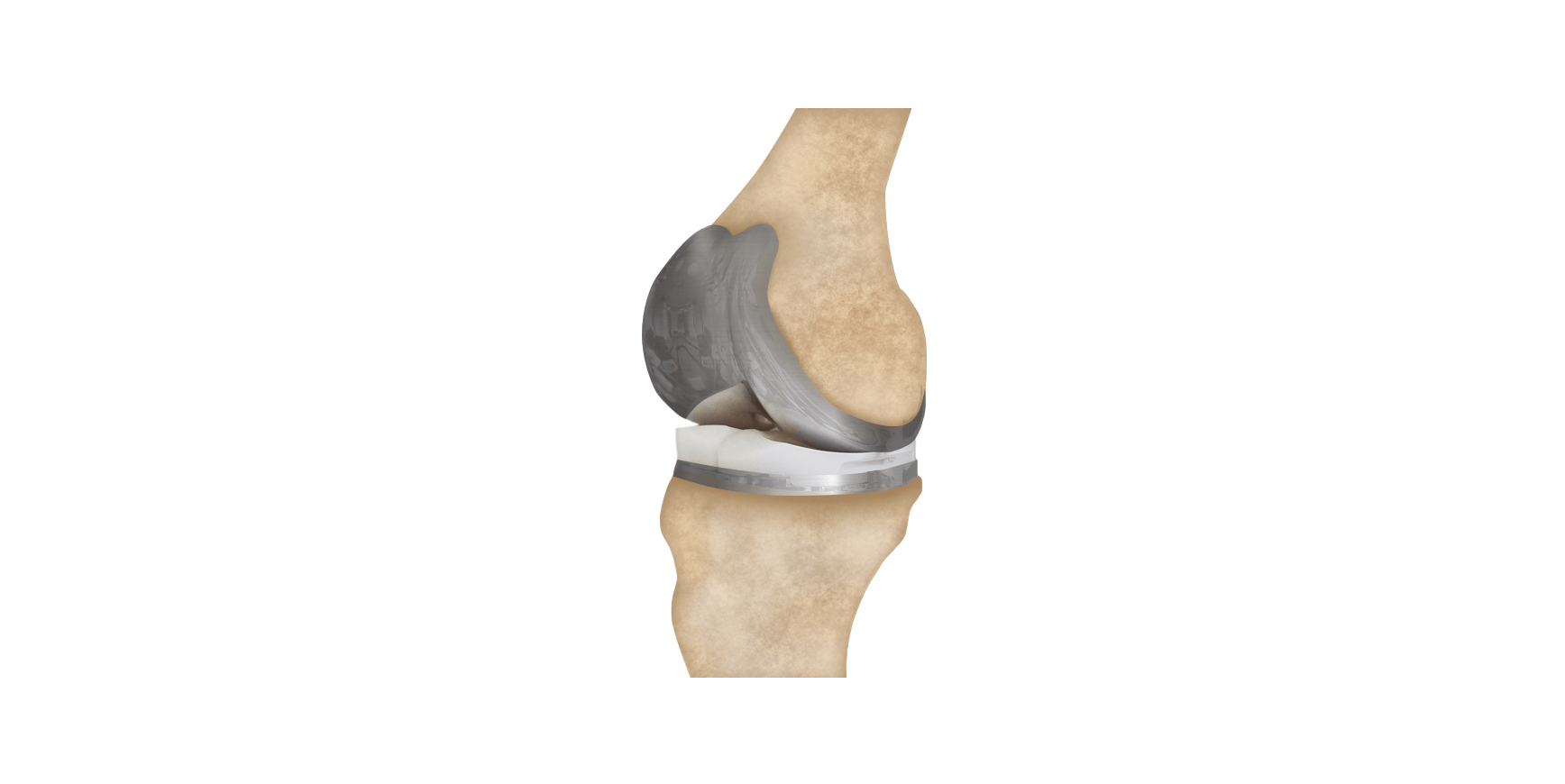 Knee Replacement | Understand the Types, Risks and Recalls