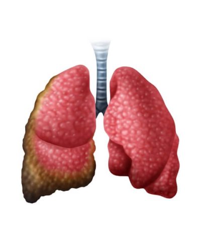 Pleural mesothelioma illustration