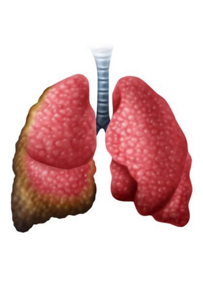 Pleural mesothelioma illustration