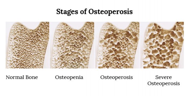 Infographic showing the the Stages of Osteoperosis