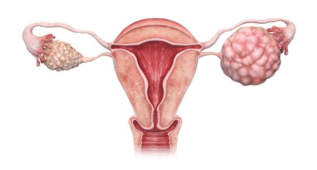 Diagram of a cancerous ovary