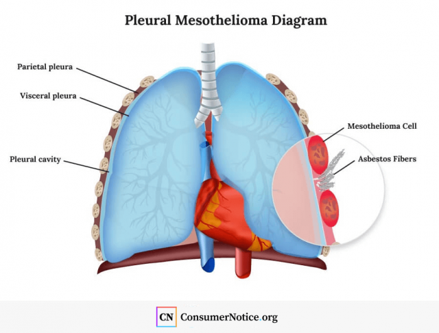 Pleural mesothelioma diagram