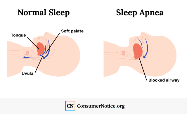 Illustration of normal sleep vs sleep apnea
