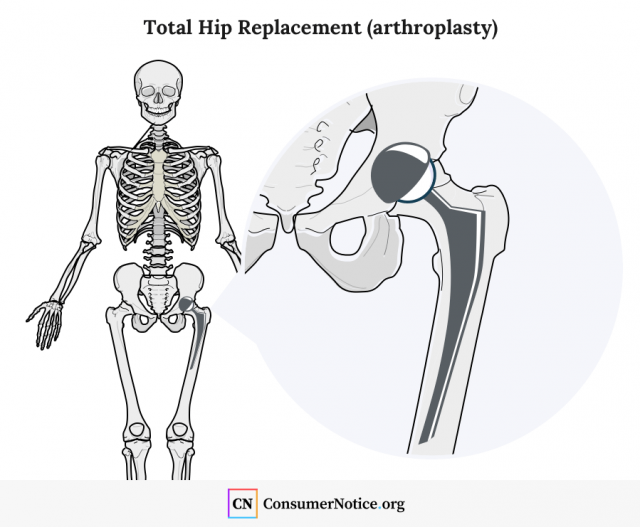 Total Hip Illustration