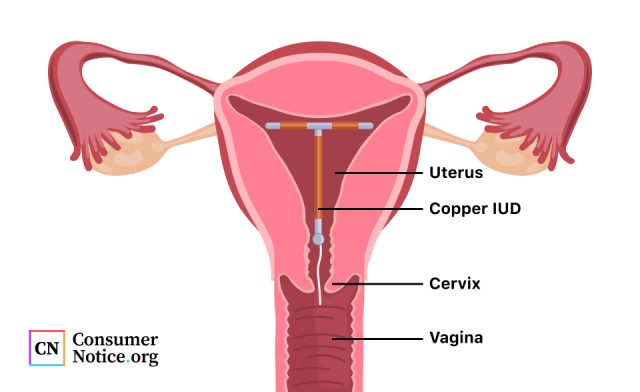 Diagram showing how a copper iud is placed within the uterus