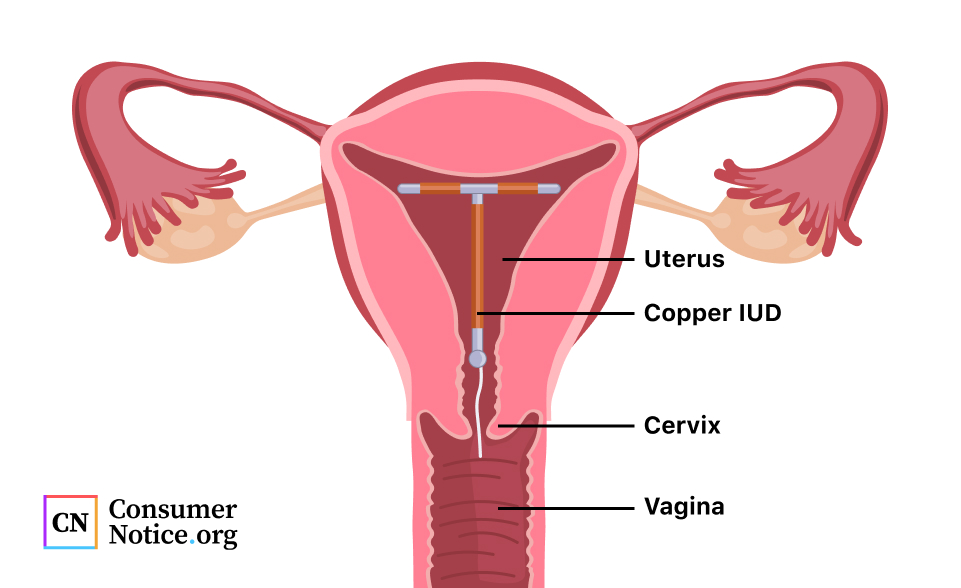 Paragard IUD | Insertion and Removal, Side Effects, Litigation