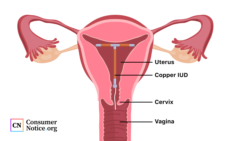 Iud Strings Cervix What Sex Feels Like With An Iud Can